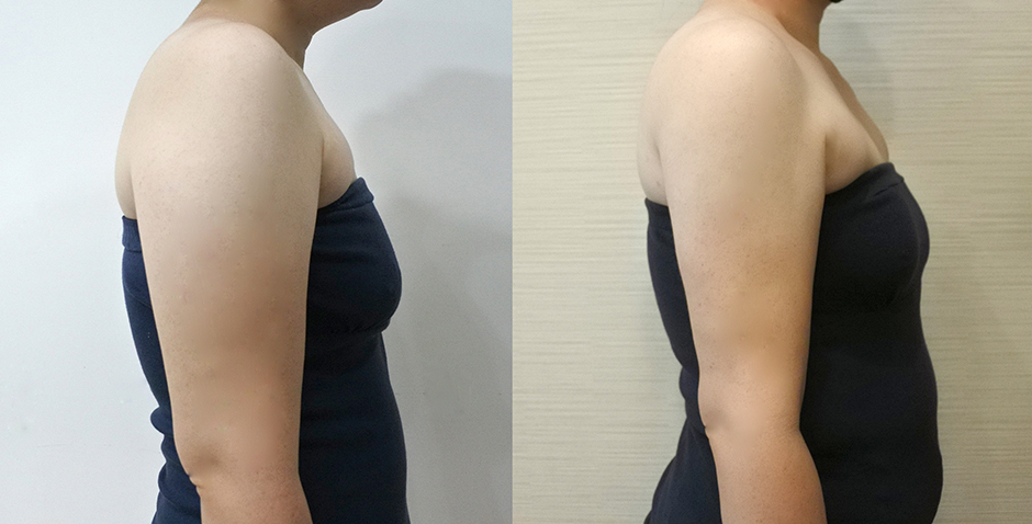 雷射減脂,楊氏羅丹,贅肉,瘦手臂